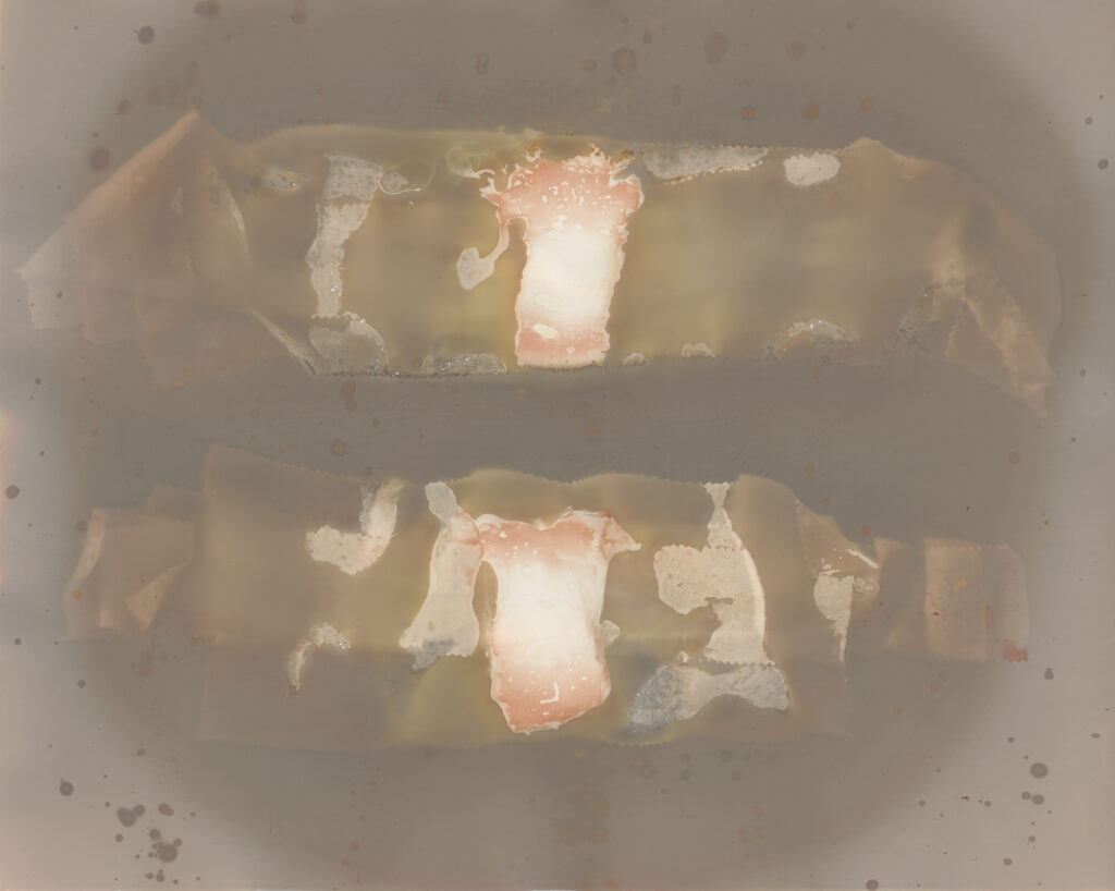 A lumen print using two bandages from a small fiber nerve biopsy test to rule out small fiber neuropathy.